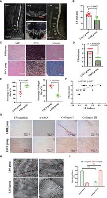 RMRP accelerates ligamentum flavum hypertrophy by regulating GSDMD-mediated pyroptosis through Gli1 SUMOylation